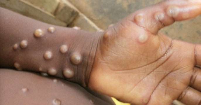 Mpox - Monkeypox - Kamituga - cas