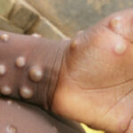 Mpox - Monkeypox - Kamituga - cas - Sud-Kivu- zones - de - santé