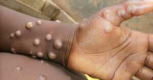 Mpox - Monkeypox - Kamituga - cas - Sud-Kivu- zones - de - santé