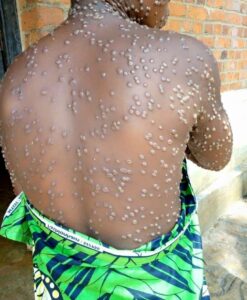 MonkeyPox