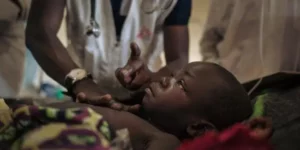 ROUGEOLE L’épidémie de rougeole continue de sévir dans la province du Sud-Kivu