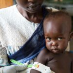Kwashiorkor au Soudan du Sud